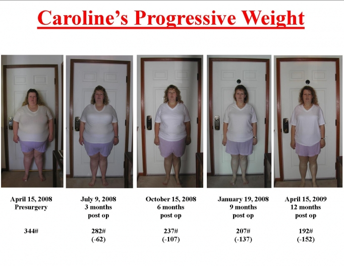 Progressive Weight Loss Pictures
